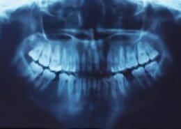 An oral dental X-ray of a patient displayed at Unique Dental of Framingham, Massachusetts.