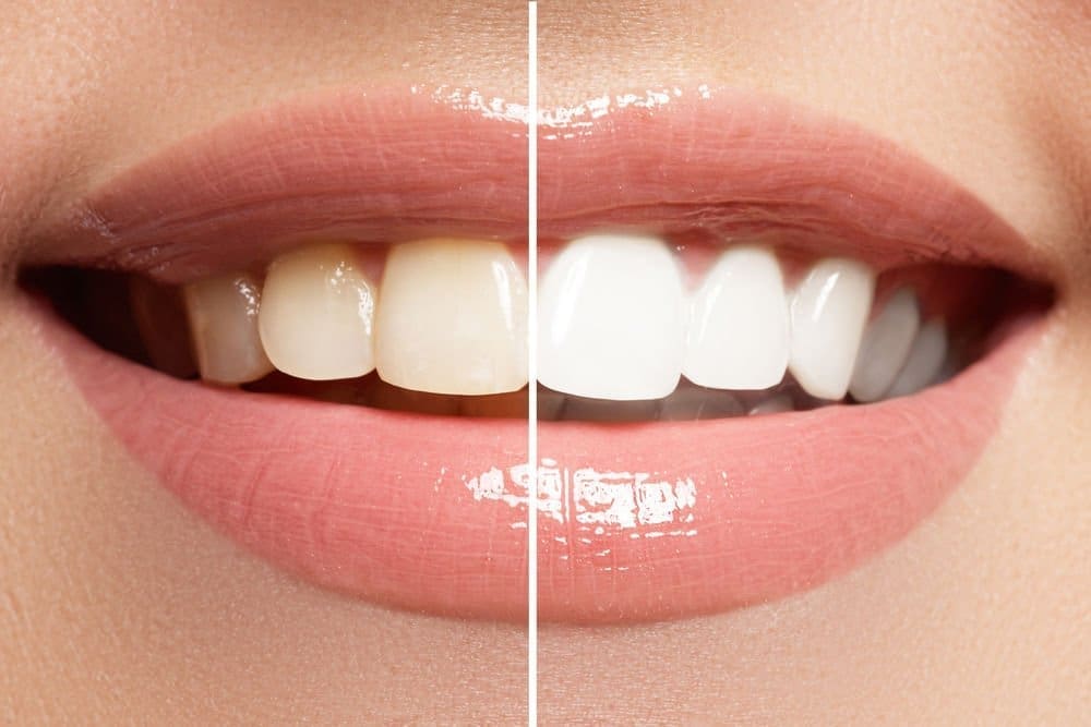 Teeth whitening before-and-after comparison at Unique Dental of Framingham.