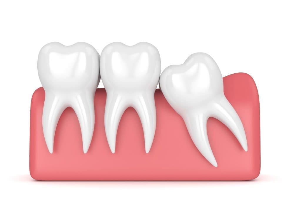 Wisdom tooth removal services at Unique Dental of Framingham.